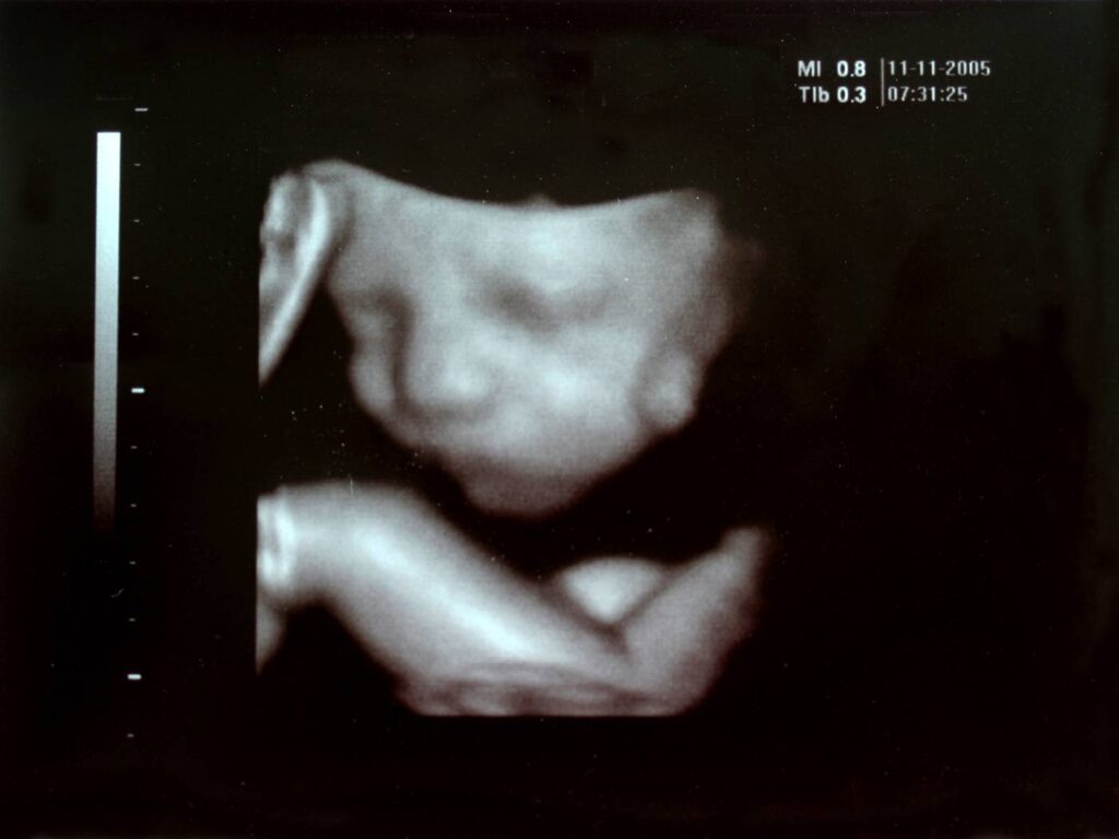 An ultrasound of a baby at six months old